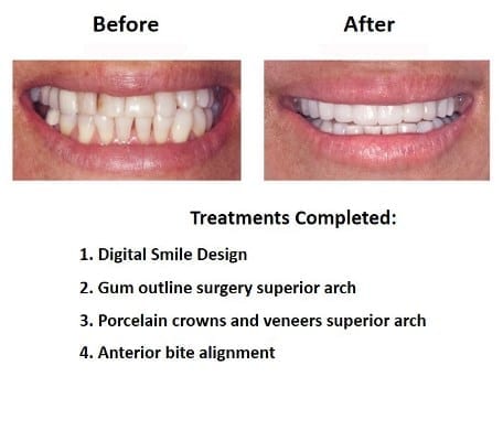 Smile-Design-Lima-Dentist-Smiles-Peru-3