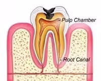 root canal smiles peru