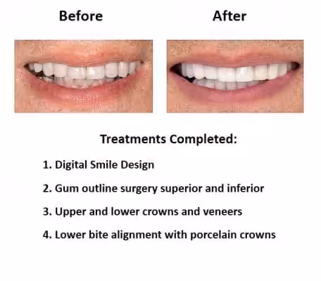 oral-rehabilitation-smiles-peru-case-study-john-3-4 oral-rehabilitation-smiles-peru-case-study-john-3-4