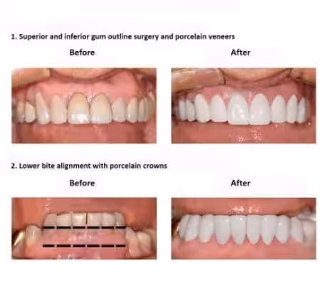 oral-rehabilitation-smiles-peru-case-study-john-4-3 oral-rehabilitation-smiles-peru-case-study-john-4-3