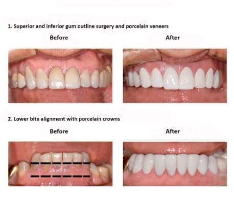 oral-rehabilitation-smiles-peru-case-study-john-4-3