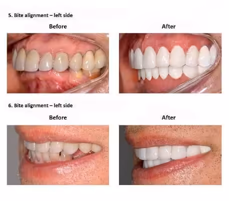 oral-rehabilitation-smiles-peru-case-study-john-6-3 oral-rehabilitation-smiles-peru-case-study-john-6-3