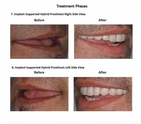 All on Six Dental Implants Smiles Peru Hybrid Proshesis (1)