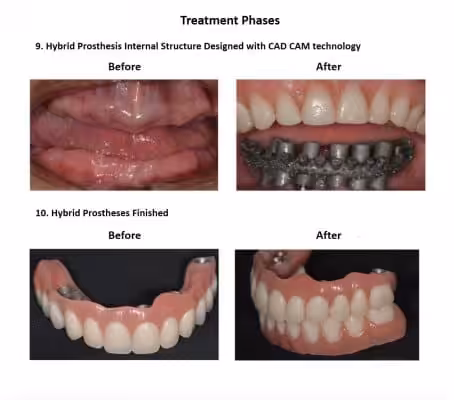 All on Six Dental Implants Smiles Peru Hybrid Proshesis (2)