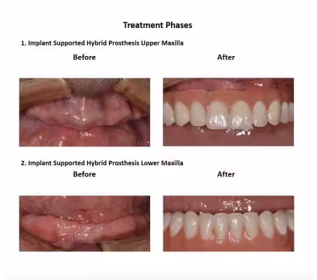 All on Six Dental Implants Smiles Peru Hybrid Proshesis (6)