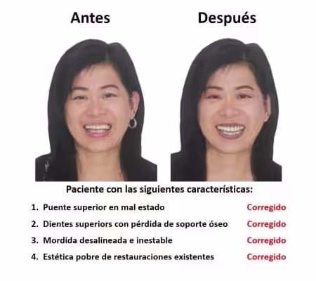 Implantes Dentales con Protesis Hibrida Smiles Peru (1) Implantes Dentales con Protesis Hibrida Smiles Peru (1)