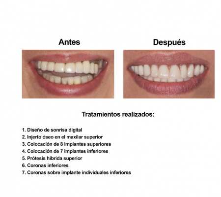 Implantes Dentales con Protesis Hibrida Smiles Peru (2)