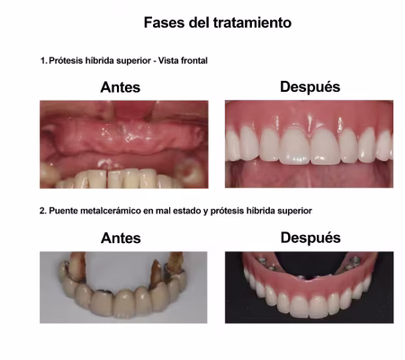 Implantes Dentales con Protesis Hibrida Smiles Peru (3) Implantes Dentales con Protesis Hibrida Smiles Peru (3)