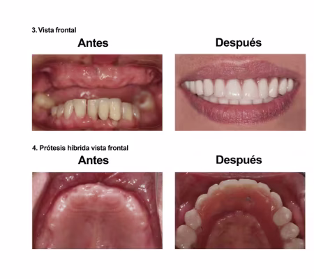 Implantes Dentales con Protesis Hibrida Smiles Peru (4) Implantes Dentales con Protesis Hibrida Smiles Peru (4)