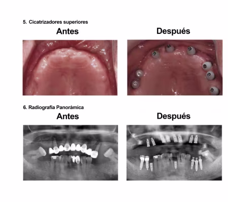 Implantes Dentales con Protesis Hibrida Smiles Peru (5) Implantes Dentales con Protesis Hibrida Smiles Peru (5)