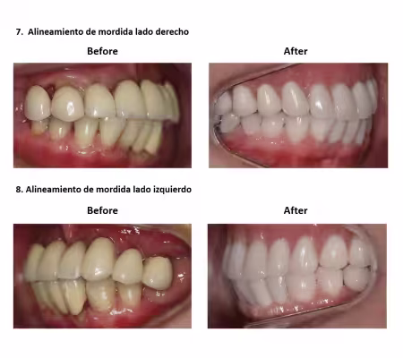 Implantes Dentales con Protesis Hibrida Smiles Peru (6) Implantes Dentales con Protesis Hibrida Smiles Peru (6)