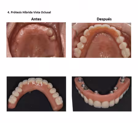 Injerto de Hueso Implantes Dentales Smiles Peru (1) Injerto de Hueso Implantes Dentales Smiles Peru (1)
