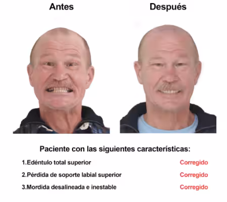 Injerto de Hueso Implantes Dentales Smiles Peru (1) Injerto de Hueso Implantes Dentales Smiles Peru (1)