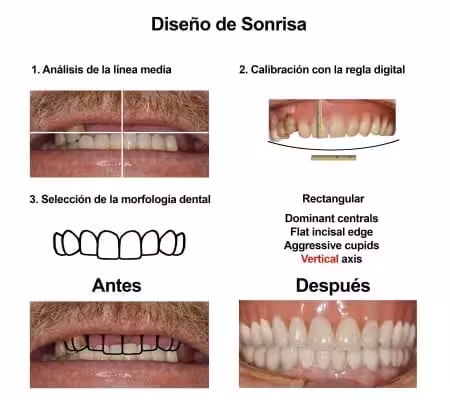 Injerto de Hueso Implantes Dentales Smiles Peru (2) Injerto de Hueso Implantes Dentales Smiles Peru (2)
