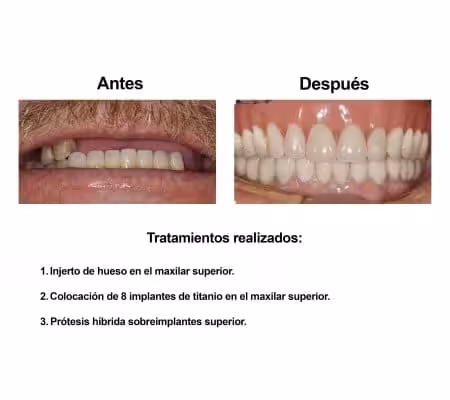 Injerto de Hueso Implantes Dentales Smiles Peru (3) Injerto de Hueso Implantes Dentales Smiles Peru (3)
