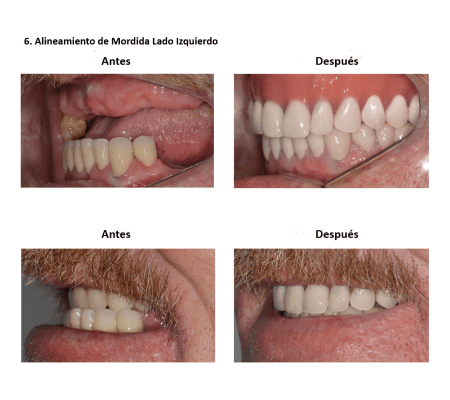 Injerto de Hueso Implantes Dentales Smiles Peru (3)