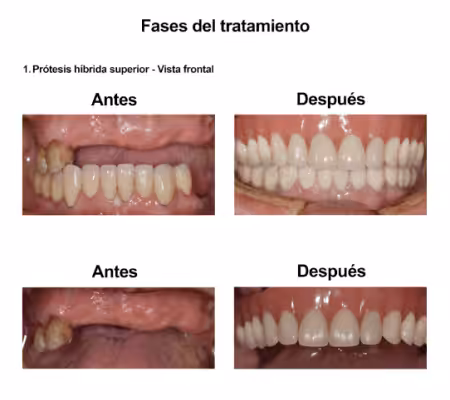 Injerto de Hueso Implantes Dentales Smiles Peru (4) Injerto de Hueso Implantes Dentales Smiles Peru (4)