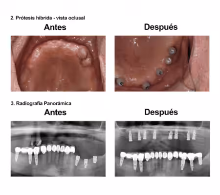 Injerto de Hueso Implantes Dentales Smiles Peru (5) Injerto de Hueso Implantes Dentales Smiles Peru (5)