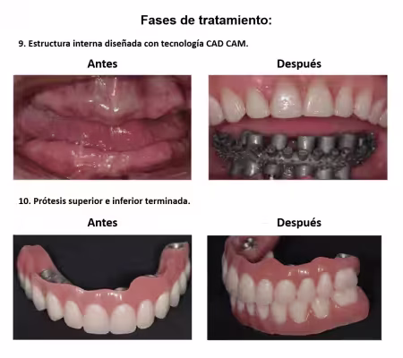 Protesis Fija sobre Implantes Dentales Smiles Peru (10) Protesis Fija sobre Implantes Dentales Smiles Peru (10)
