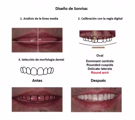 Protesis Fija sobre Implantes Dentales Smiles Peru (11) Protesis Fija sobre Implantes Dentales Smiles Peru (11)
