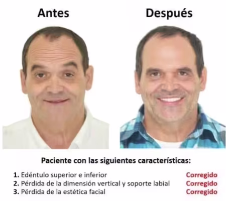 Protesis Fija sobre Implantes Dentales Smiles Peru (6) Protesis Fija sobre Implantes Dentales Smiles Peru (6)