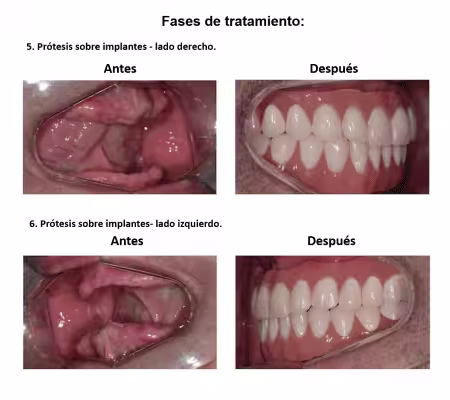 Protesis Fija sobre Implantes Dentales Smiles Peru (8) Protesis Fija sobre Implantes Dentales Smiles Peru (8)