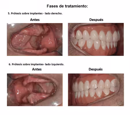 Protesis Fija sobre Implantes Dentales Smiles Peru (8) Protesis Fija sobre Implantes Dentales Smiles Peru (8)