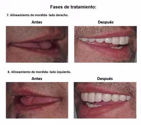 Protesis Fija sobre Implantes Dentales Smiles Peru (9) Protesis Fija sobre Implantes Dentales Smiles Peru (9)