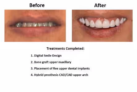 Dental Implants Lima Smiles Peru (2) Dental Implants Lima Smiles Peru (2)