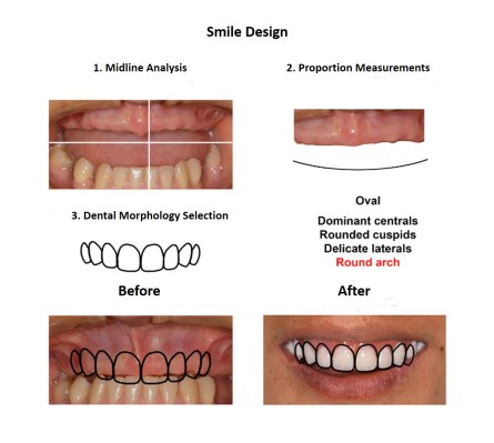 Dental Implants Lima Smiles Peru (3)