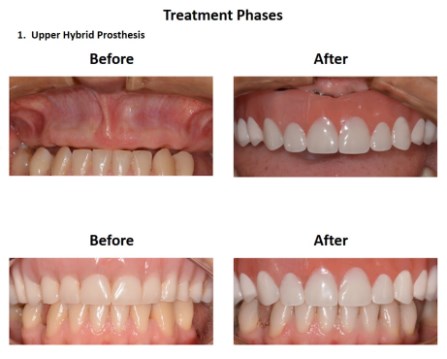 Dental Implants Lima Smiles Peru (4)