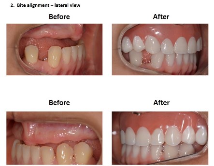 Dental Implants Lima Smiles Peru (5)