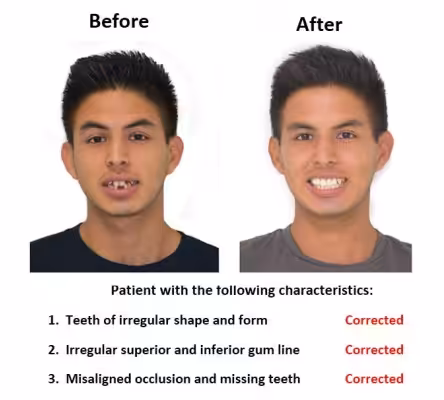 Dental Implants and Porcelain Crowns (1) Dental Implants and Porcelain Crowns (1)