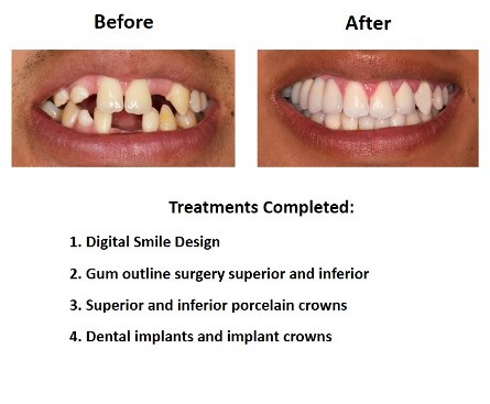 Dental Implants and Porcelain Crowns (2)