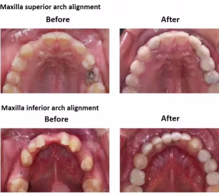 Dental Implants and Porcelain Crowns (4) Dental Implants and Porcelain Crowns (4)