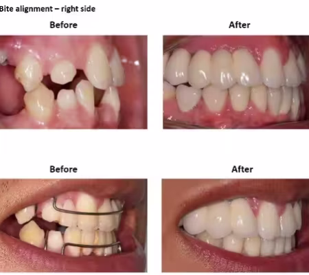 Dental Implants and Porcelain Crowns (5) Dental Implants and Porcelain Crowns (5)