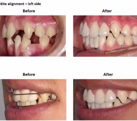 Dental Implants and Porcelain Crowns (6) Dental Implants and Porcelain Crowns (6)