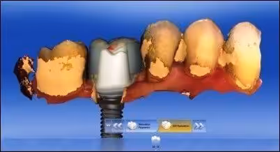 Implant-Crown-Smiles-Peru-CAD-CAM