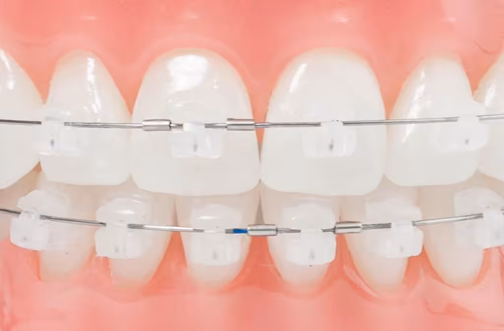 Brackets-Autoligables-Damon-Smiles Peru