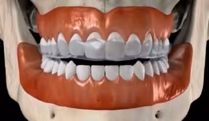 night guard bruxism Smiles Peru