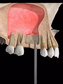 Sinus Lift Elevacion de Seno Smiles Peru Sinus Lift Elevacion de Seno Smiles Peru