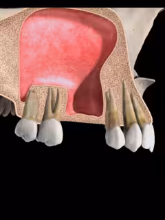 Sinus Lift Smiles Peru Dental Implants Sinus Lift Smiles Peru Dental Implants