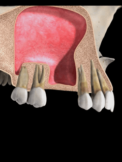 Sinus Lift Smiles Peru Dental Implants
