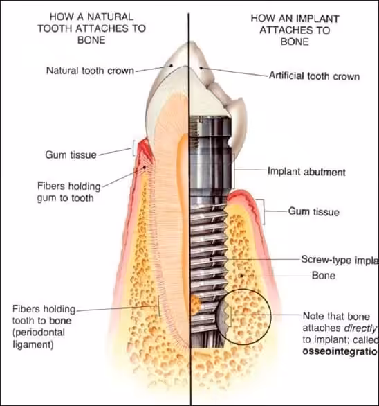osseointegration Dental Implant Smiles Peru osseointegration Dental Implant Smiles Peru