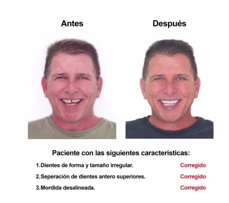 Carillas de Porcelana Smiles Peru (1) Carillas de Porcelana Smiles Peru (1)