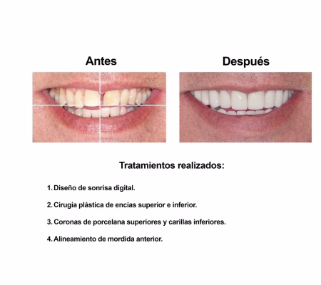 Carillas de Porcelana Smiles Peru (2) Carillas de Porcelana Smiles Peru (2)