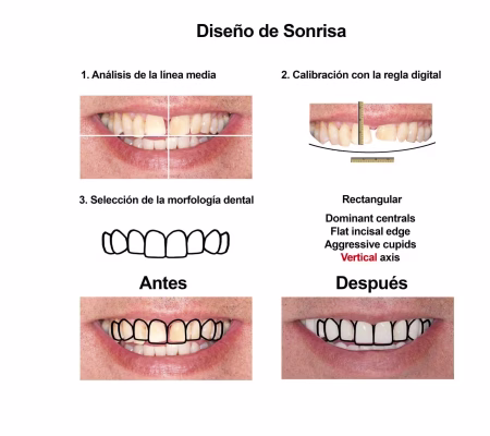 Carillas de Porcelana Smiles Peru (3) Carillas de Porcelana Smiles Peru (3)