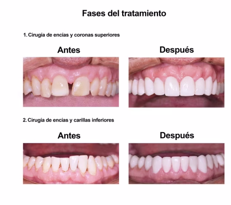 Carillas de Porcelana Smiles Peru (4) Carillas de Porcelana Smiles Peru (4)