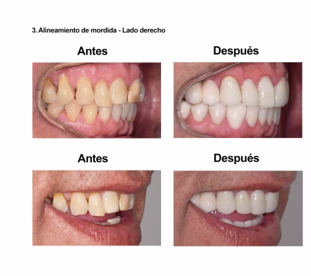Carillas de Porcelana Smiles Peru (5) Carillas de Porcelana Smiles Peru (5)