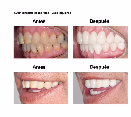 Carillas de Porcelana Smiles Peru (6) Carillas de Porcelana Smiles Peru (6)